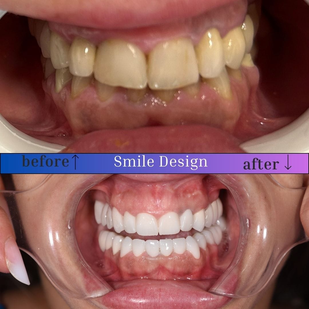 smile-design-1
